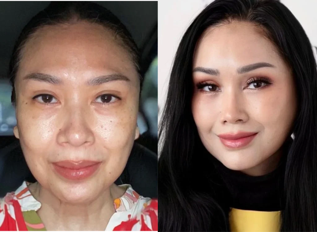 Before-After