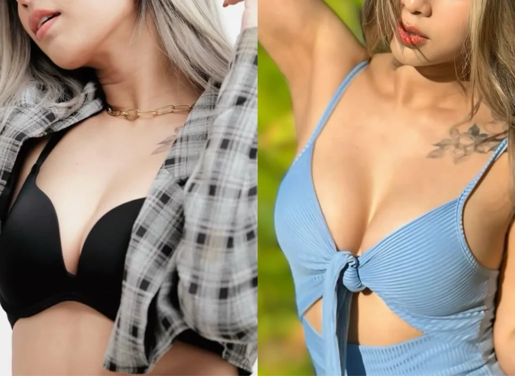 Before-After
