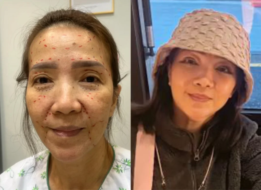Before-After
