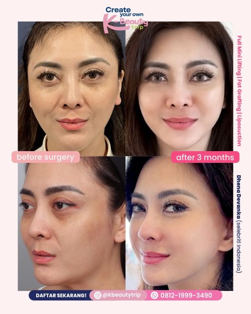 dhena-devanka-before-after