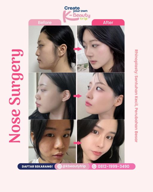nose-surgery-before-after-k-beautytrips
